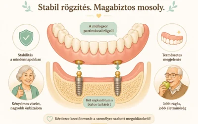 Implantátummal rögzített fogsor – mikor éri meg?